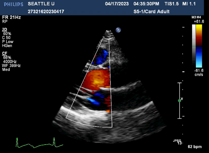 Parasternal View with Trace Mitral Regurgitation