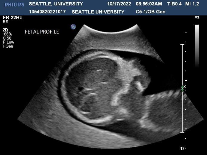 Phantom Fetal Profile