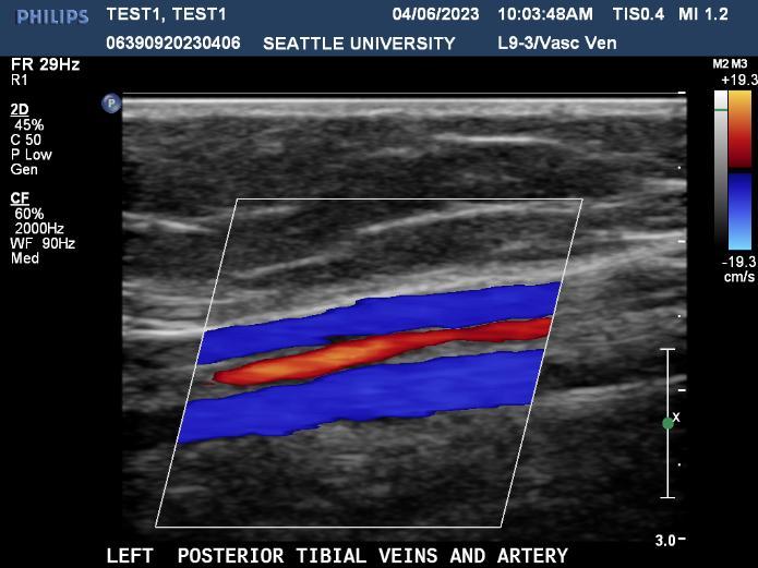 Left Posterior Tibial Veins and Artery